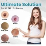 Mole And Wart Removal Pen Non Invasive Mole And Wart Removal - Image 2